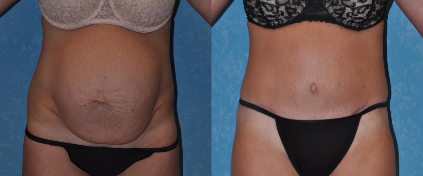 Before & After Abdominoplasty Case 291 View #1 View in Toledo, Ohio