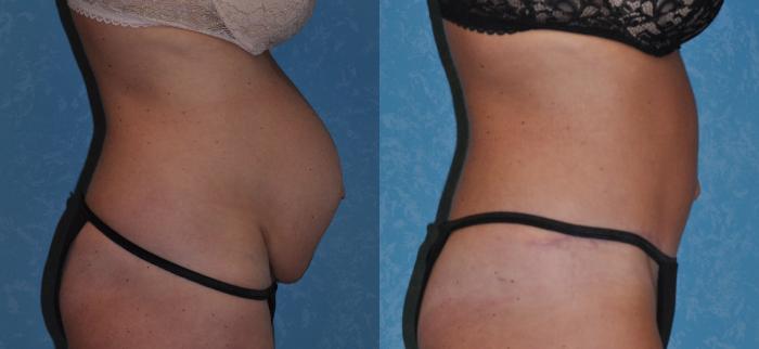 Before & After Abdominoplasty Case 291 View #2 View in Toledo, Ohio