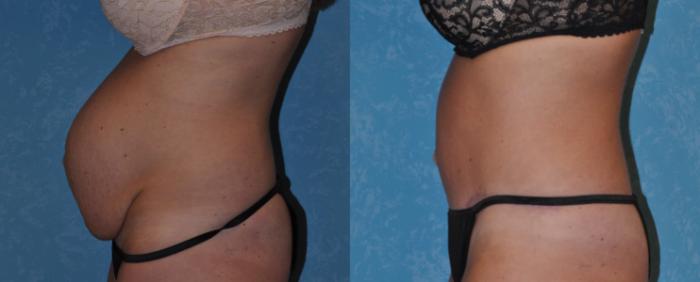 Before & After Abdominoplasty Case 291 View #3 View in Toledo, Ohio