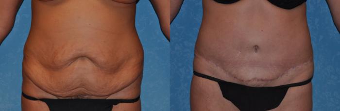 Before & After Abdominoplasty Case 303 View #1 View in Toledo, Ohio