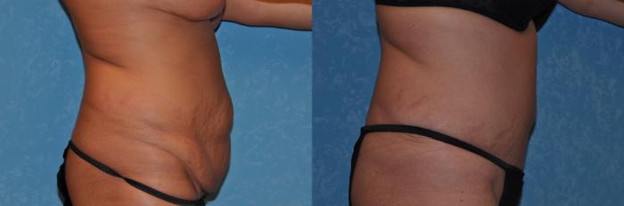 Before & After Abdominoplasty Case 303 View #2 View in Toledo, Ohio