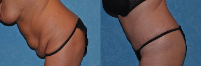 Before & After Abdominoplasty Case 303 View #3 View in Toledo, Ohio