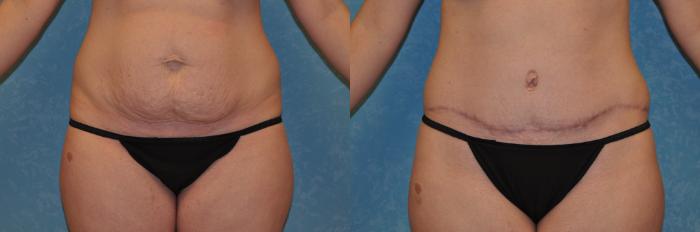 Before & After Abdominoplasty Case 398 Front View in Toledo, Ohio