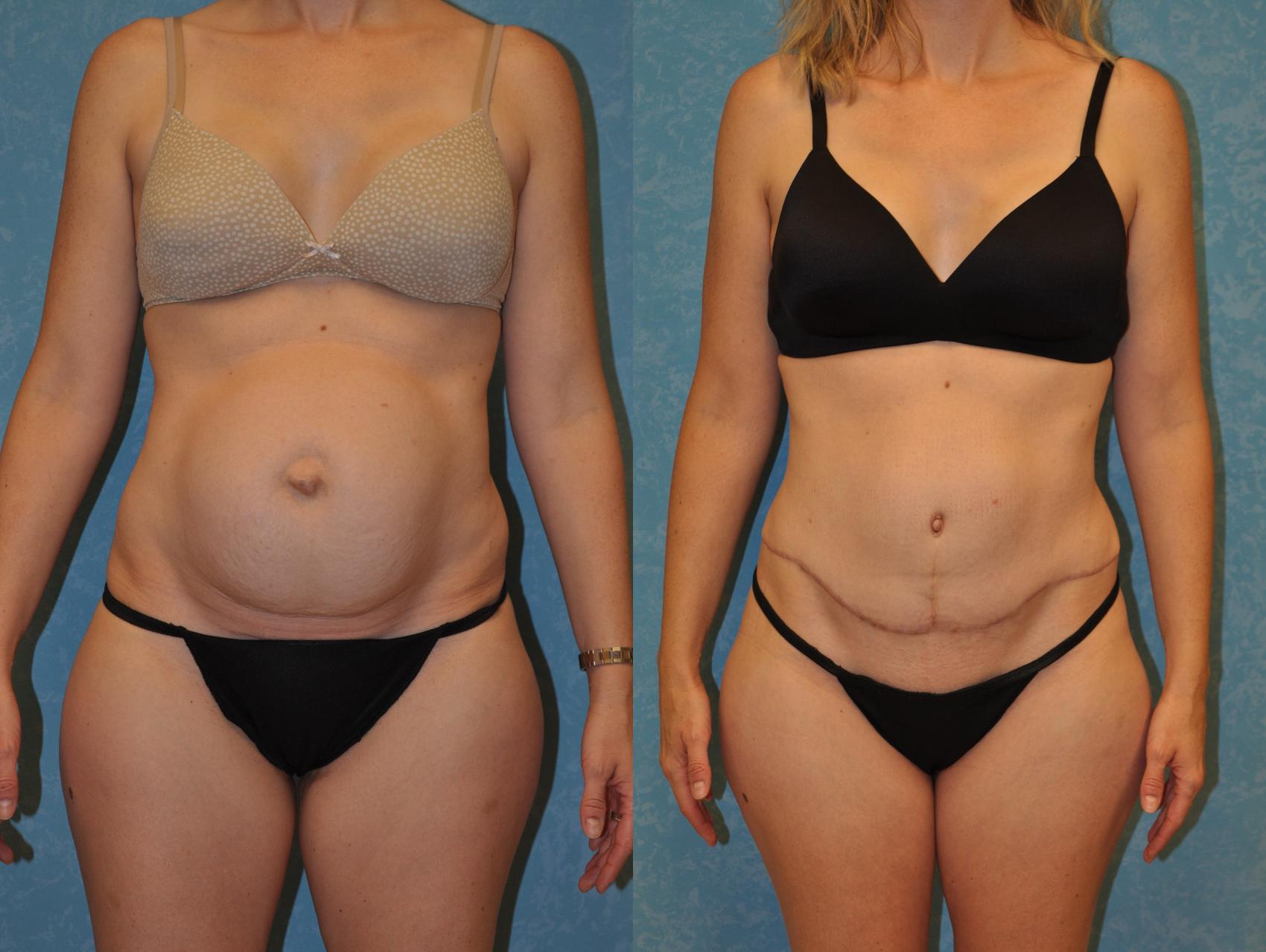 Before & After Abdominoplasty Case 413 Front View in Toledo, Ohio
