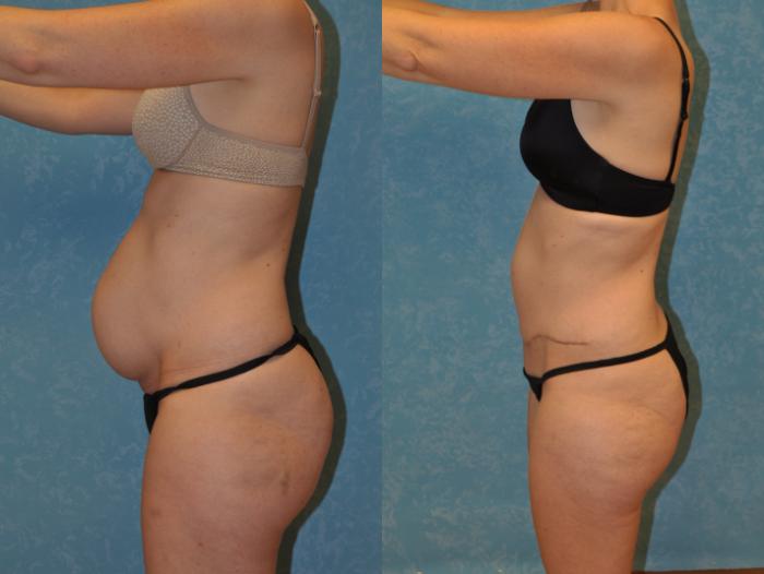 Before & After Abdominoplasty Case 413 Left Side View in Toledo, Ohio