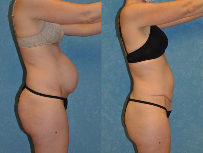 Before & After Abdominoplasty Case 413 Right Side View in Toledo, Ohio