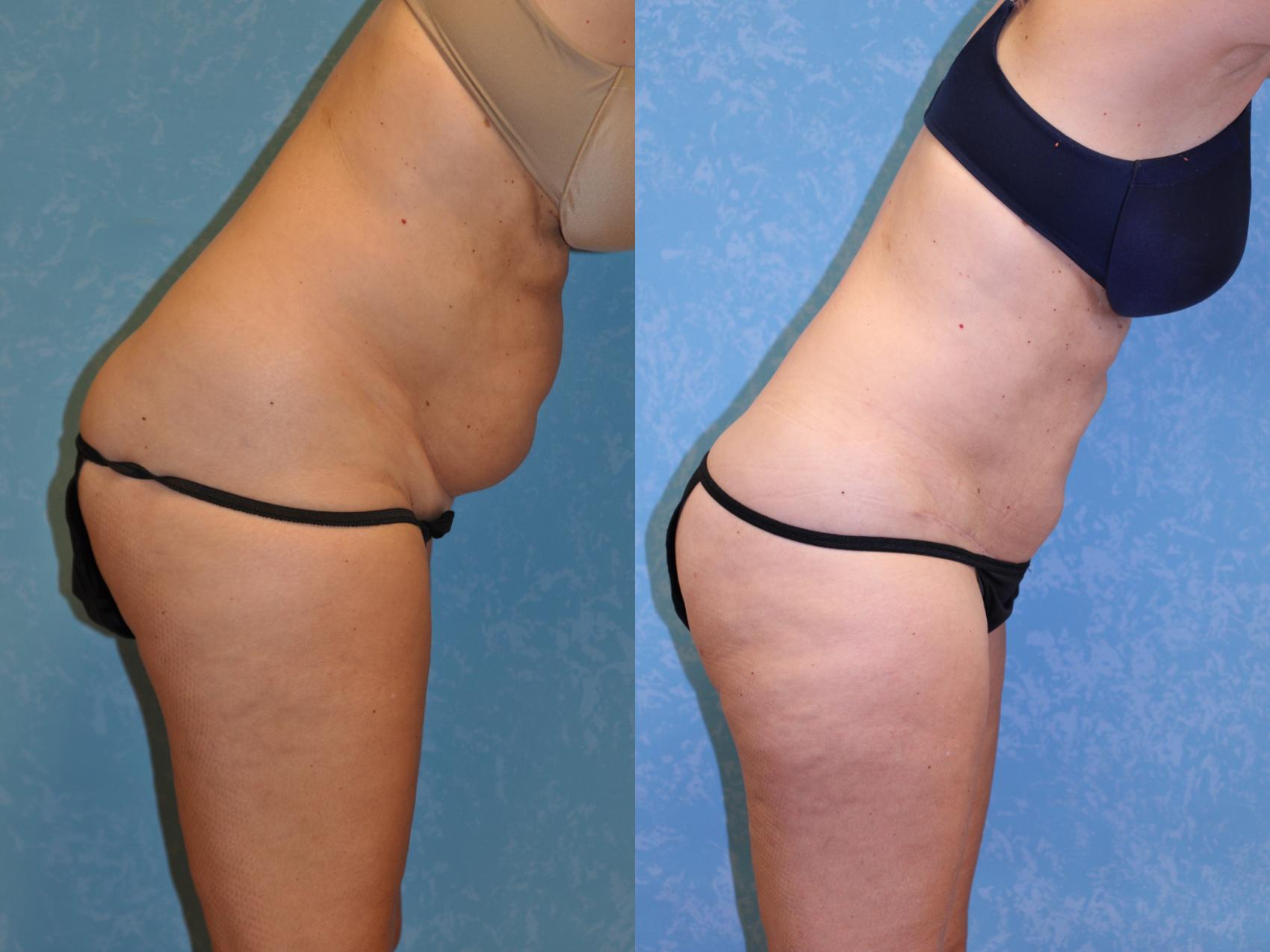 Before & After Abdominoplasty Case 440 Bent Forward View in Toledo, Ohio