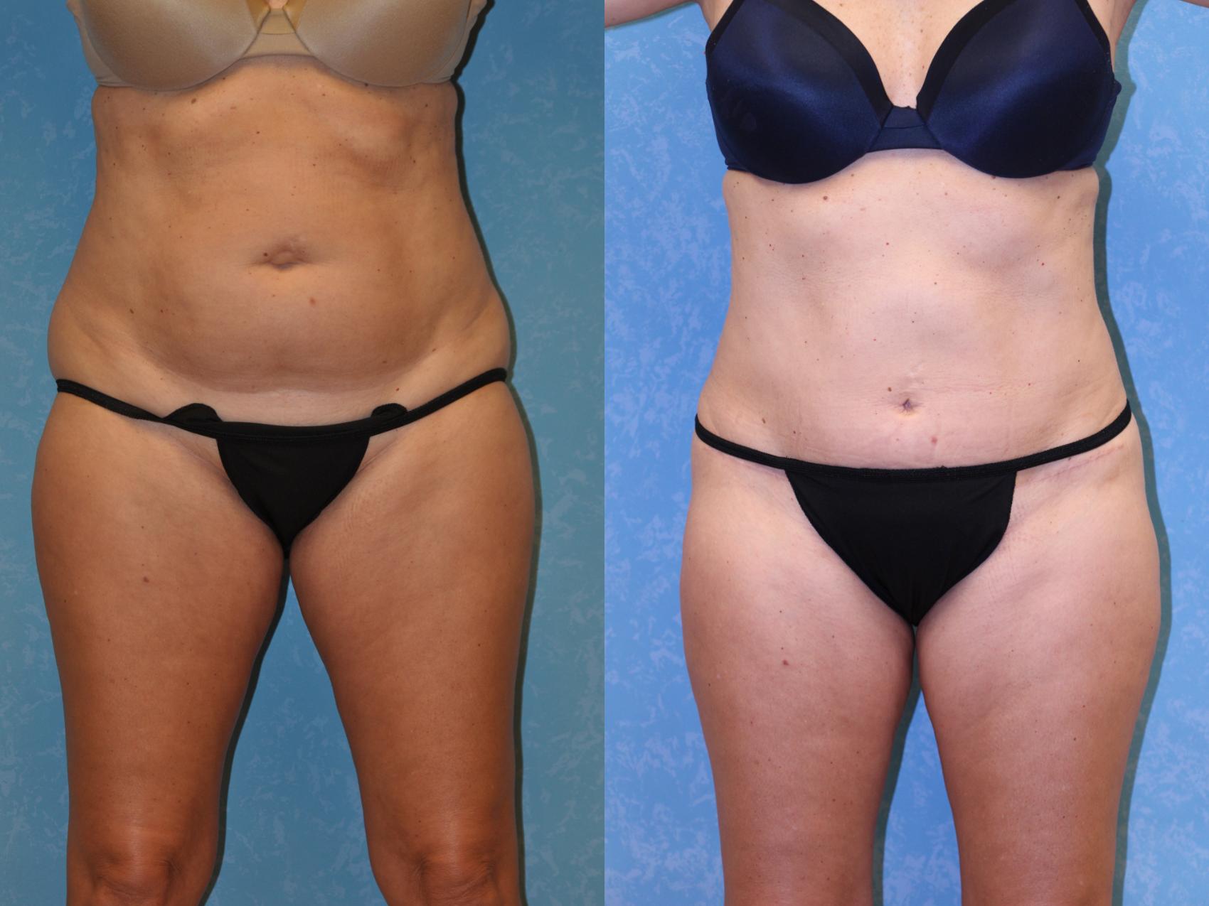 Before & After Abdominoplasty Case 440 Front View in Toledo, Ohio