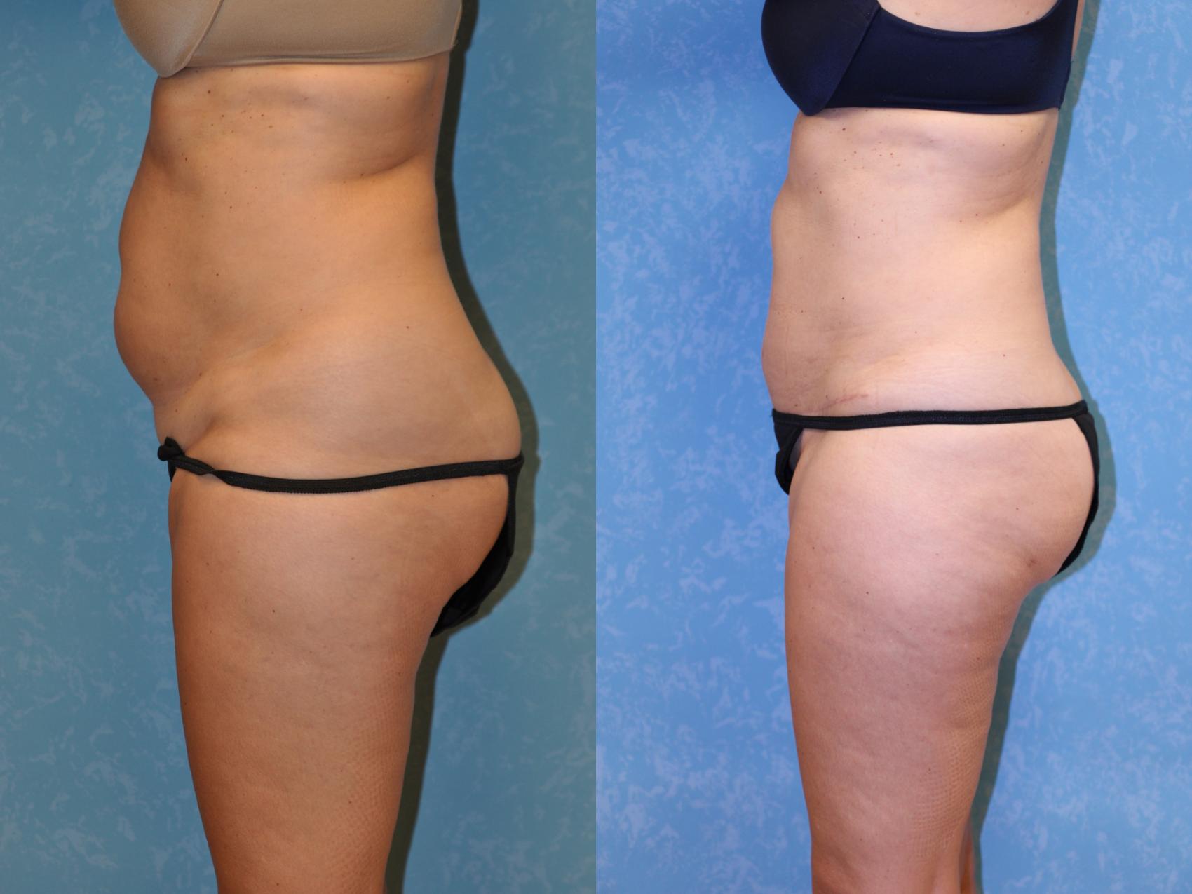 Before & After Abdominoplasty Case 440 Left Side View in Toledo, Ohio