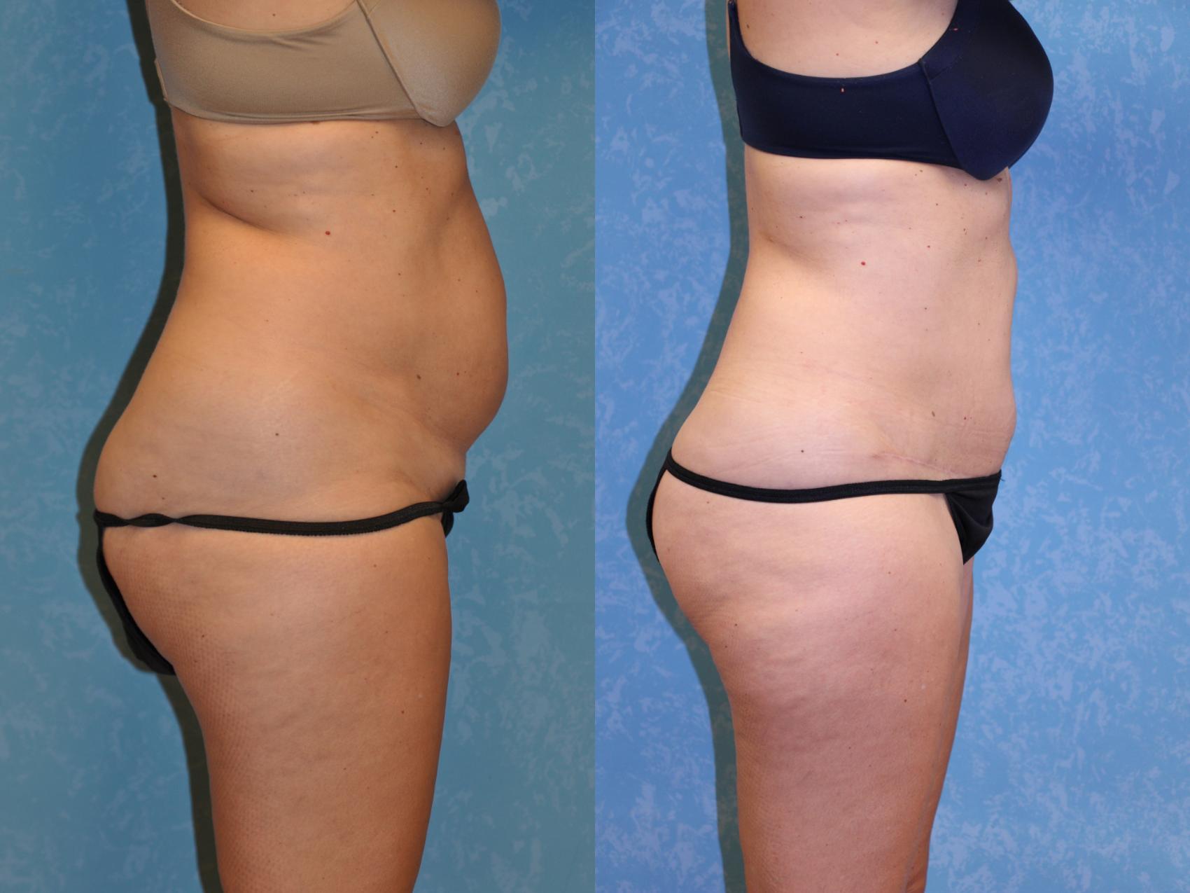 Before & After Abdominoplasty Case 440 Right Side View in Toledo, Ohio