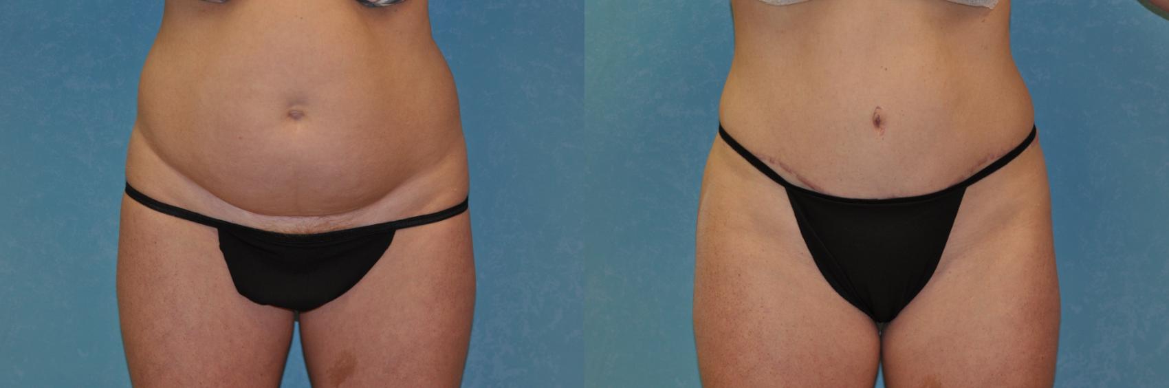 Before & After Abdominoplasty Case 442 Front View in Toledo, Ohio
