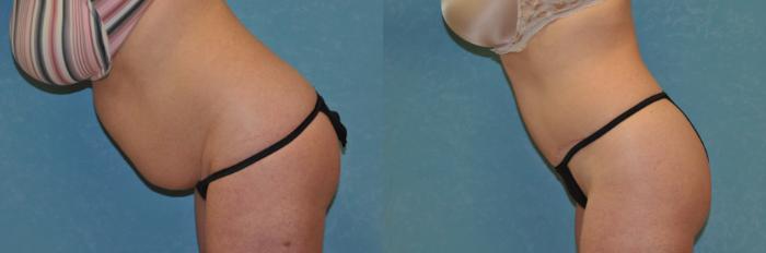 Before & After Abdominoplasty Case 442 Left Side View in Toledo, Ohio