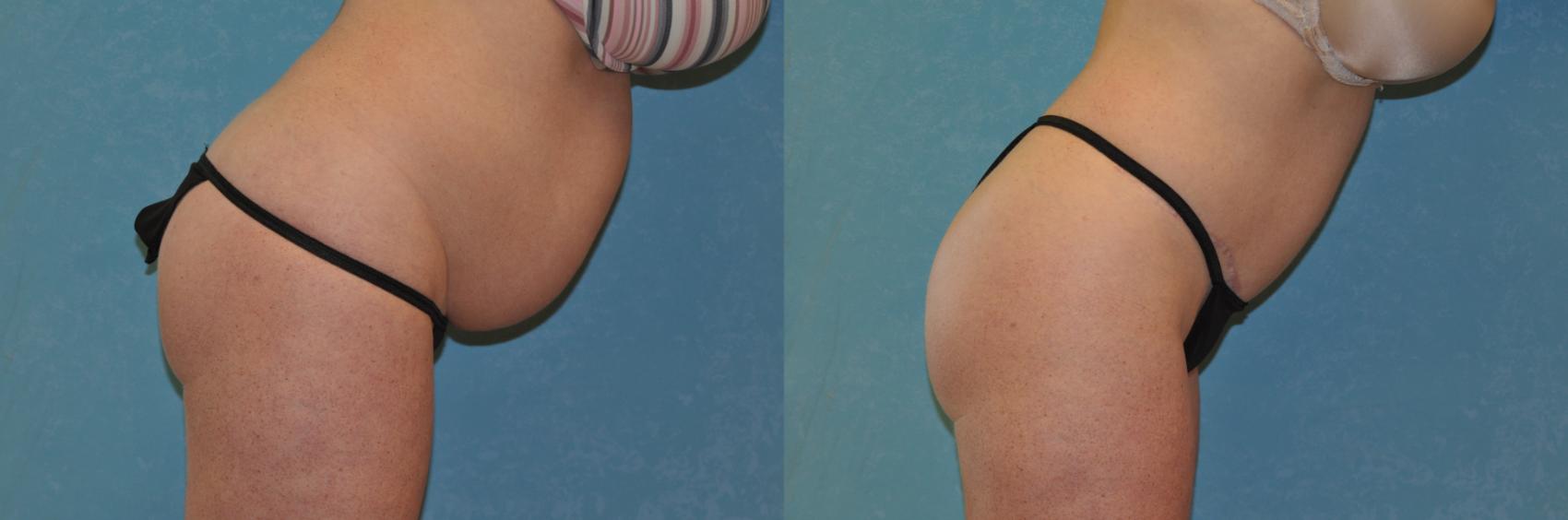 Before & After Abdominoplasty Case 442 Right Side View in Toledo, Ohio