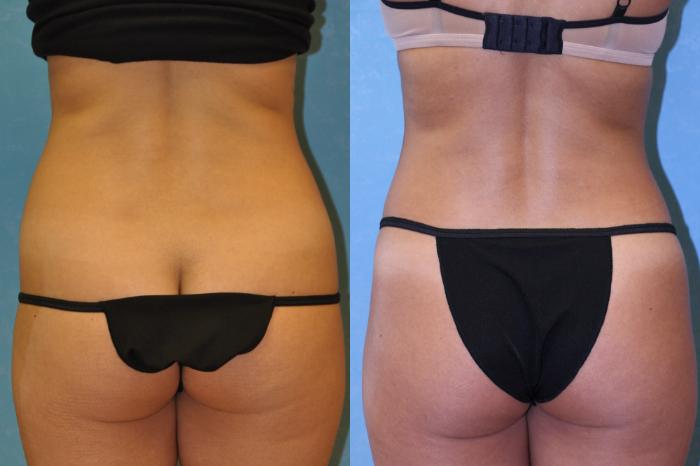 Before & After Liposuction Case 444 Back View in Toledo, Ohio