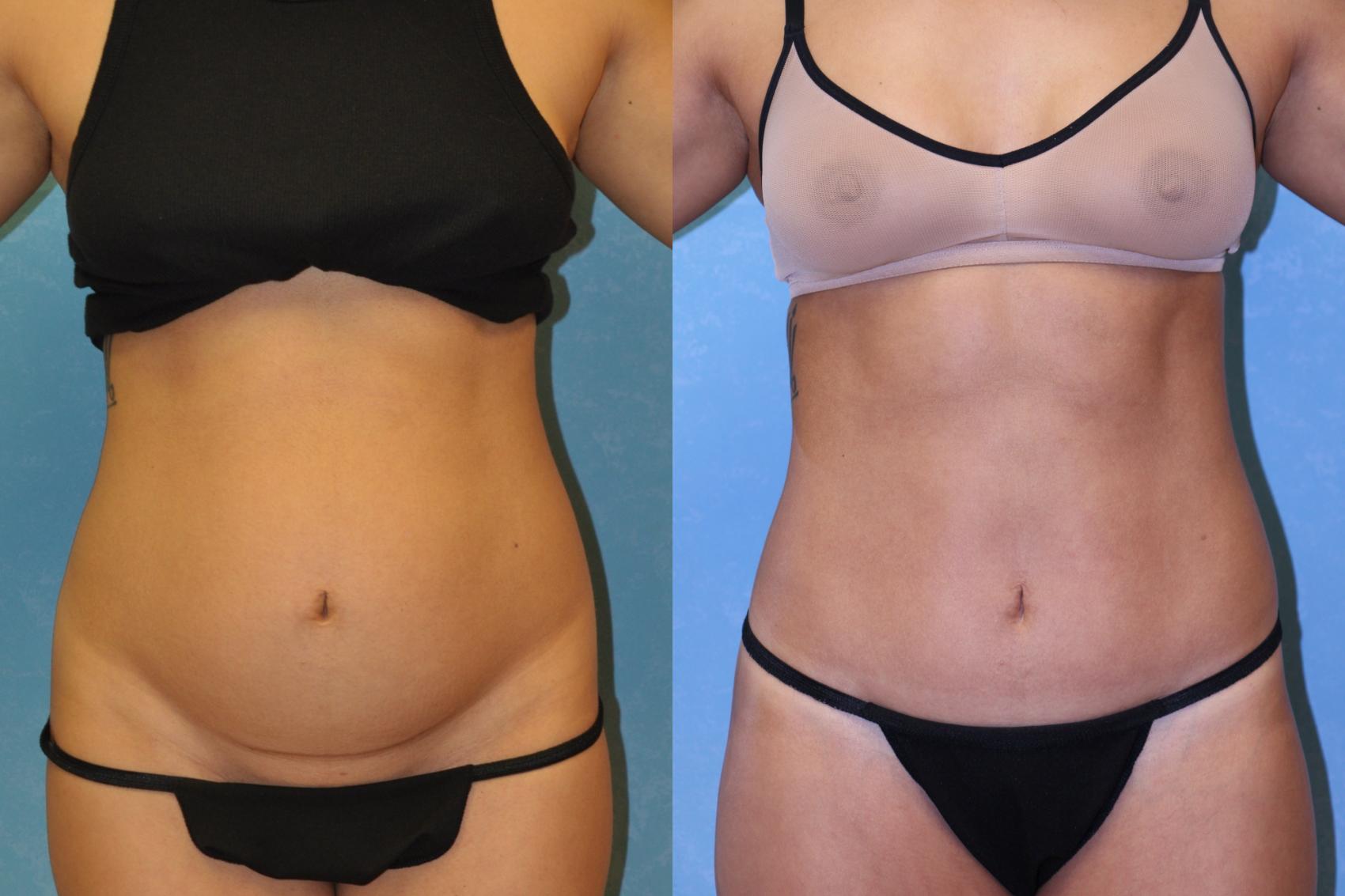 Before & After Abdominoplasty Case 444 Front View in Toledo, Ohio