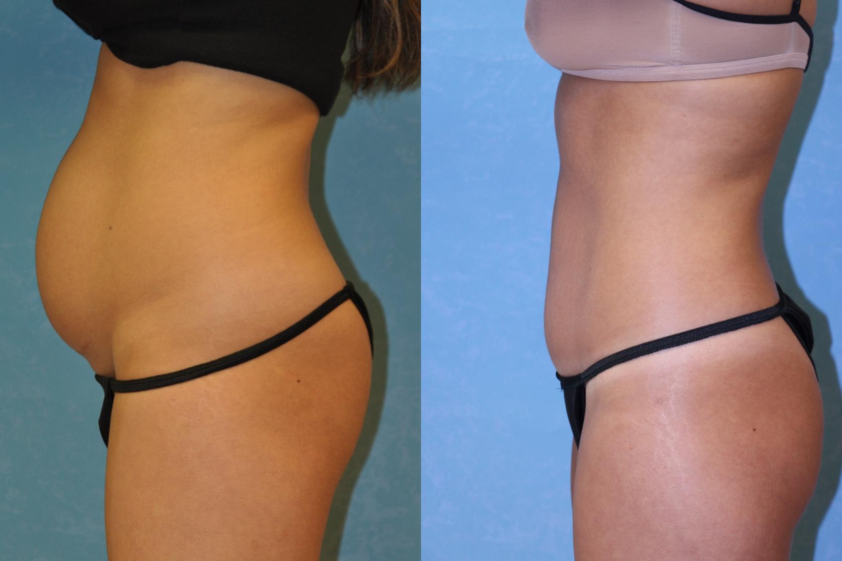 Before & After Abdominoplasty Case 444 Left Side View in Toledo, Ohio