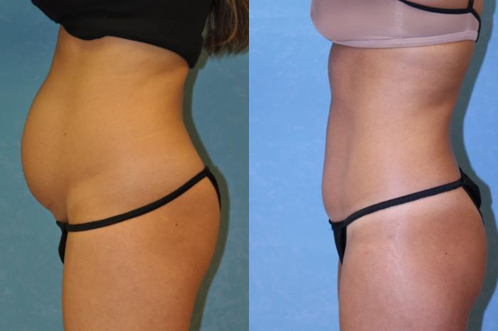 Before & After Liposuction Case 444 Left Side View in Toledo, Ohio