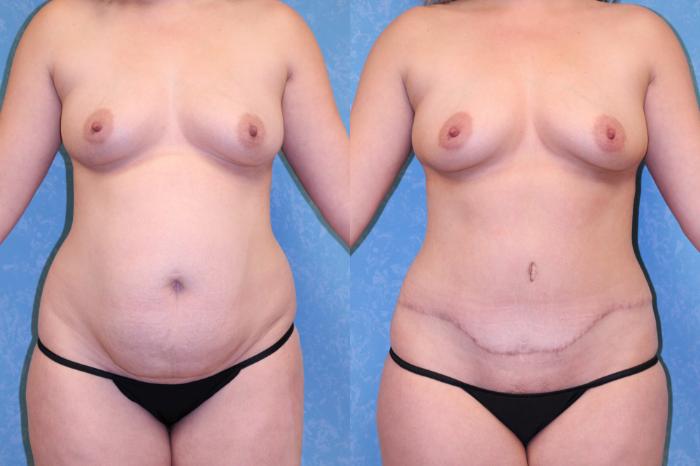 Before & After Abdominoplasty Case 459 Front View in Toledo, Ohio