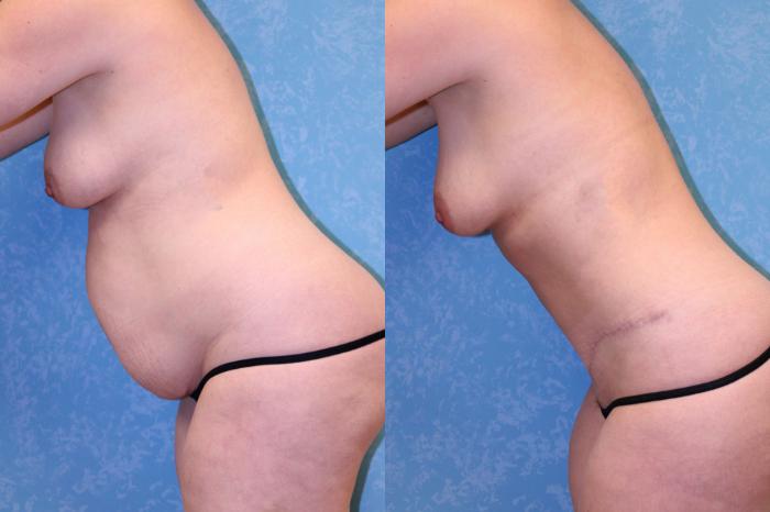 Before & After Abdominoplasty Case 459 Left Bent Forward View in Toledo, Ohio