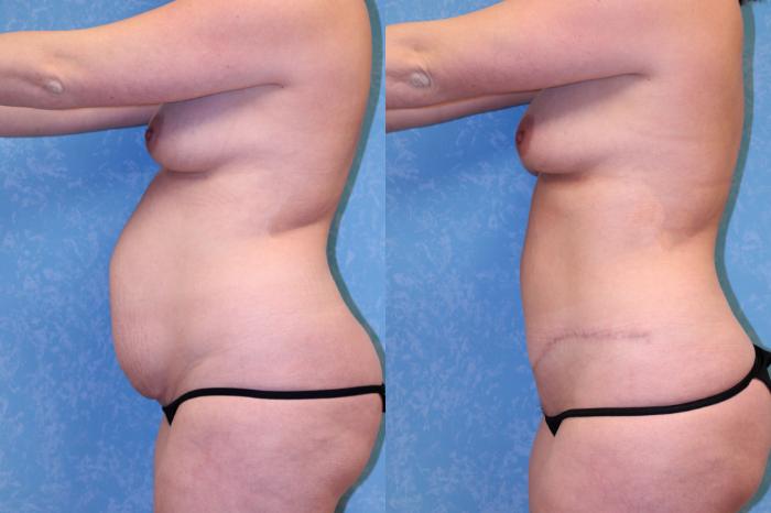 Before & After Abdominoplasty Case 459 Left Side View in Toledo, Ohio
