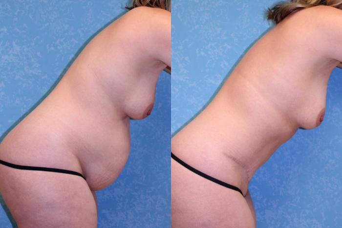 Before & After Abdominoplasty Case 459 Right Bent Forward View in Toledo, Ohio