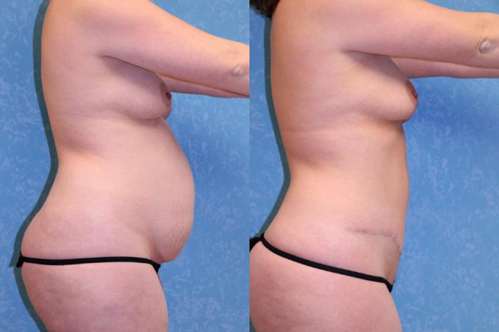 Before & After Abdominoplasty Case 459 Right Side View in Toledo, Ohio