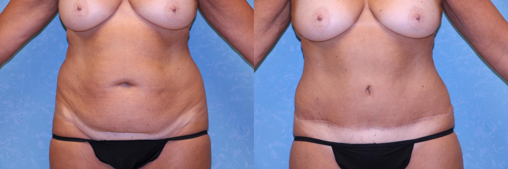 Before & After Abdominoplasty Case 497 Front View in Toledo, Ohio