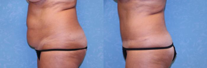 Before & After Abdominoplasty Case 497 Left Side View in Toledo, Ohio