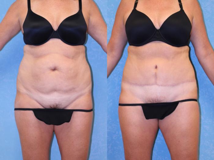 Before & After Liposuction Case 513 Front View in Toledo, Ohio