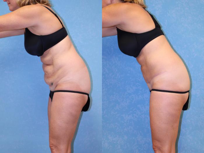 Before & After Abdominoplasty Case 513 Left Side View in Toledo, Ohio