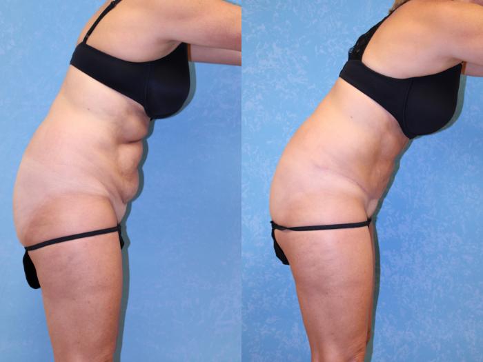 Before & After Abdominoplasty Case 513 Right Side View in Toledo, Ohio