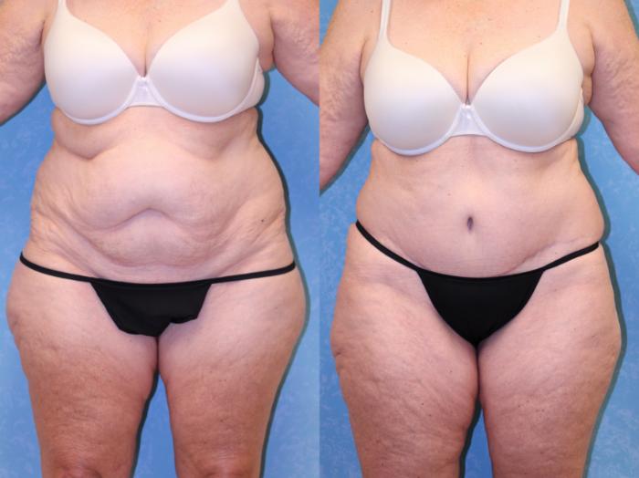 Before & After Liposuction Case 518 Front View in Toledo, Ohio