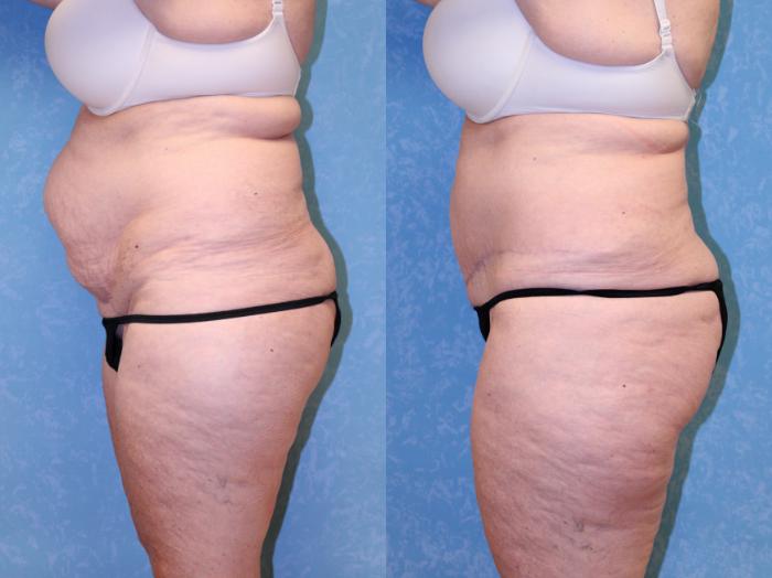 Before & After Abdominoplasty Case 518 Left Side View in Toledo, Ohio