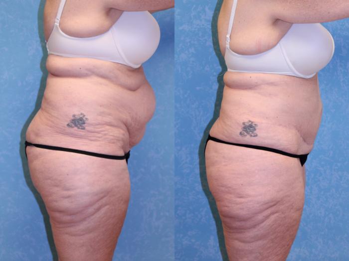 Before & After Abdominoplasty Case 518 Right Side View in Toledo, Ohio