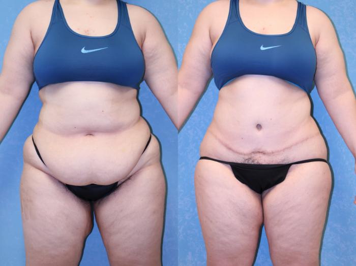 Before & After Abdominoplasty Case 522 Front View in Toledo, Ohio