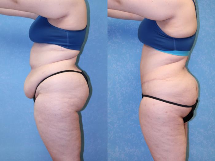 Before & After Abdominoplasty Case 522 Left Side View in Toledo, Ohio