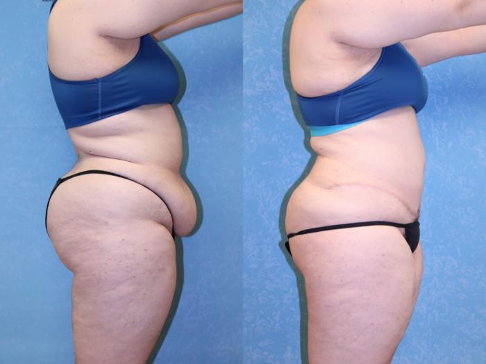 Before & After Abdominoplasty Case 522 Right Side View in Toledo, Ohio