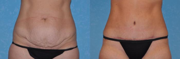 Before & After Abdominoplasty Case 537 Front View in Toledo, Ohio