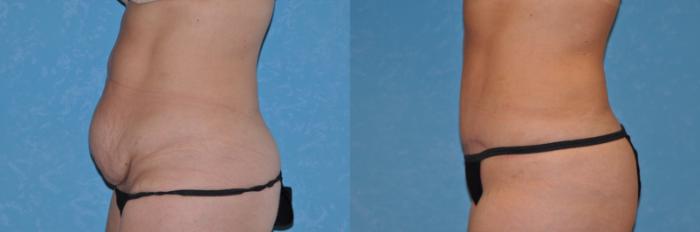 Before & After Abdominoplasty Case 537 Left Side View in Toledo, Ohio