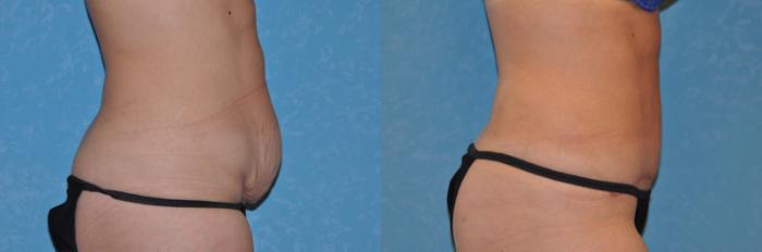 Before & After Abdominoplasty Case 537 Right Side View in Toledo, Ohio