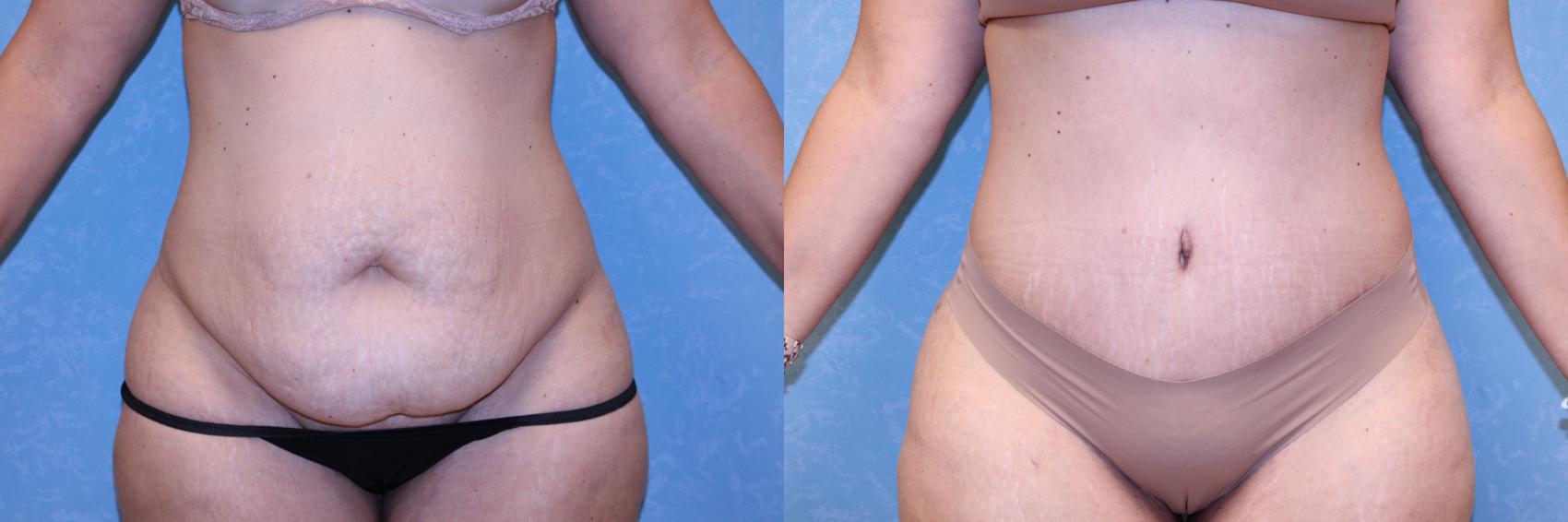 Before & After Abdominoplasty Case 564 Front View in Toledo, Ohio