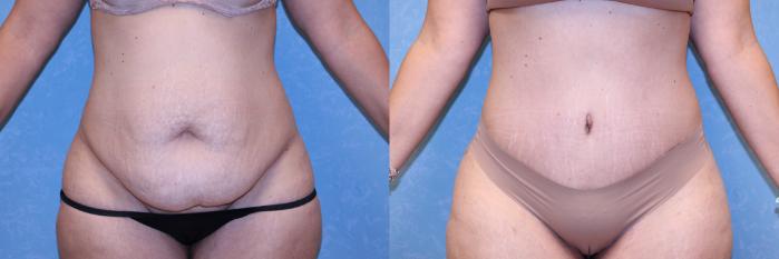 Before & After Abdominoplasty Case 564 Front View in Toledo, Ohio