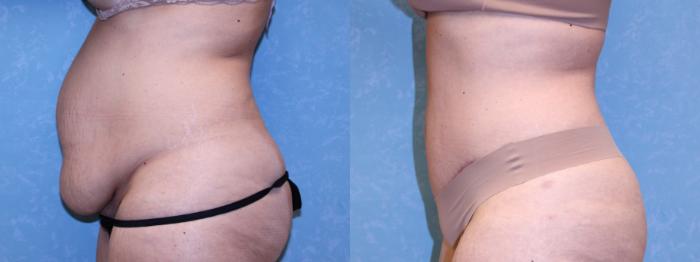 Before & After Abdominoplasty Case 564 Left Side View in Toledo, Ohio
