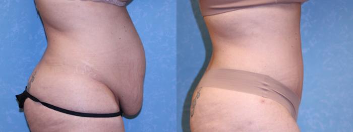 Before & After Abdominoplasty Case 564 Right Side View in Toledo, Ohio