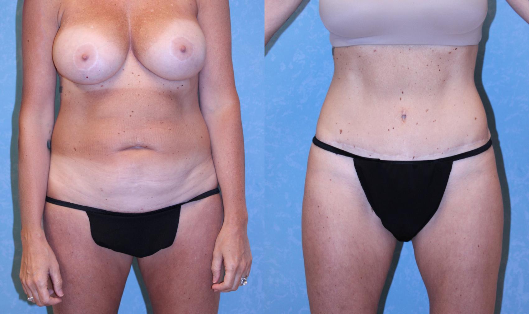 Before & After Abdominoplasty Case 583 Front View in Toledo, Ohio