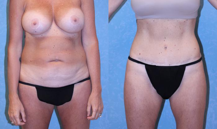 Before & After Abdominoplasty Case 583 Front View in Toledo, Ohio