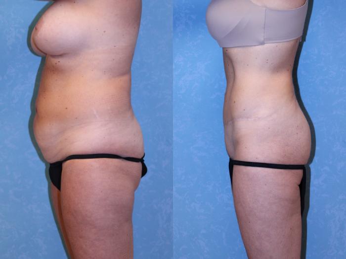 Before & After Abdominoplasty Case 583 Left Side View in Toledo, Ohio