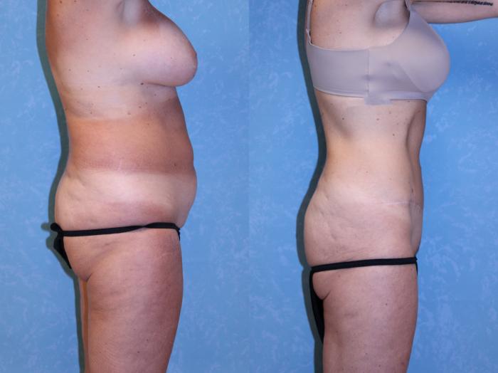 Before & After Abdominoplasty Case 583 Right Side View in Toledo, Ohio