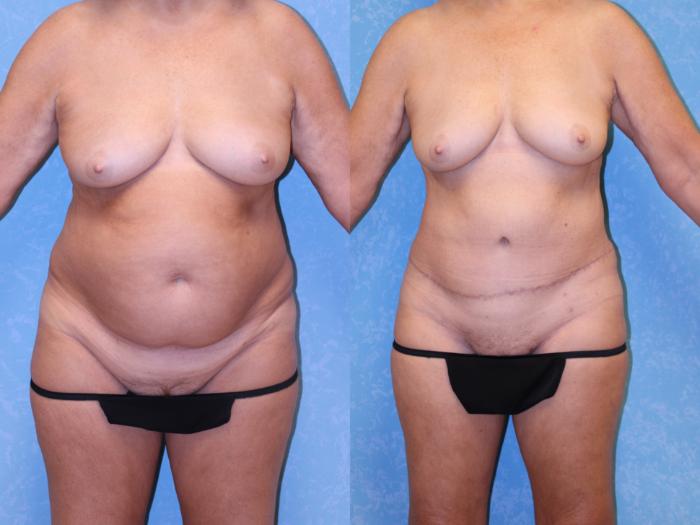 Before & After Abdominoplasty Case 600 Front View in Toledo, Ohio