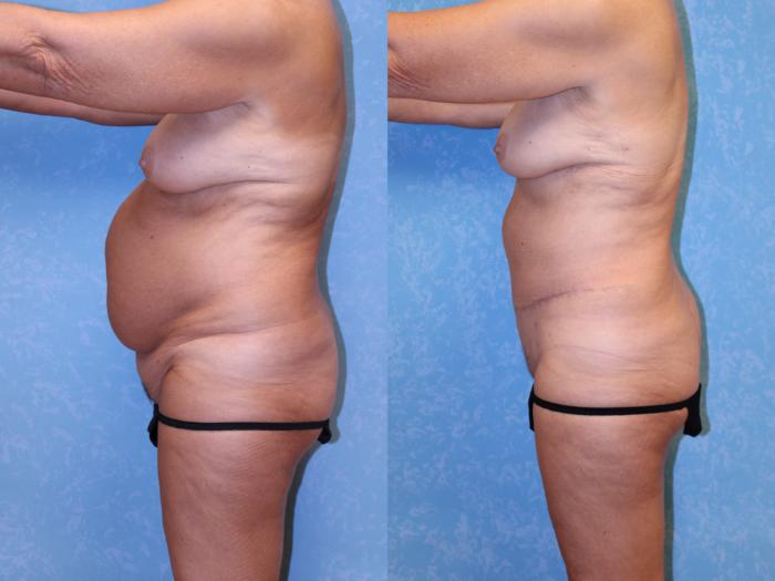 Before & After Abdominoplasty Case 600 Left Side View in Toledo, Ohio